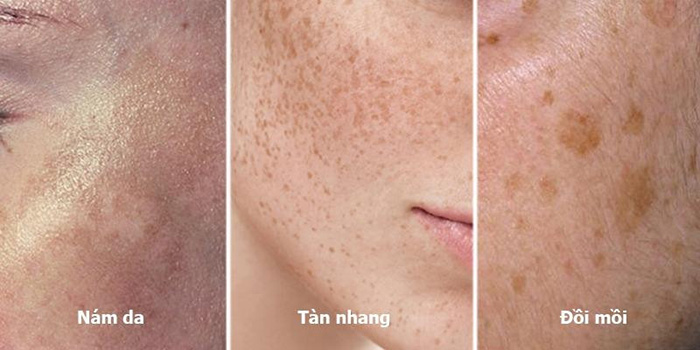 Các dấu hiệu của nám da mặt, tàn nhang và đồi mồi