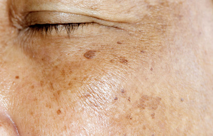 Đốm nâu là hiện tượng tăng sắc tố trên da từ nhạt đến đậm 