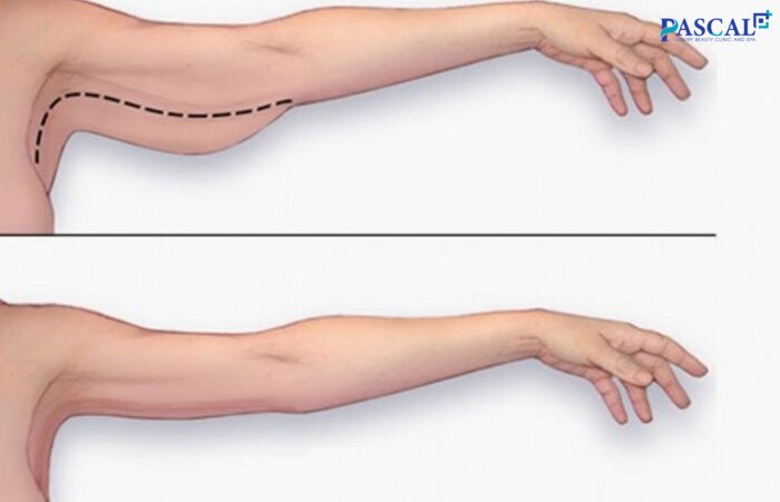 Mỡ bắp tay là mỡ thừa, chất béo tích tụ nhiều vùng bắp tay gây mất thẩm mỹ