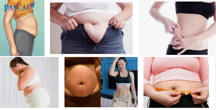 Những rắc rối của mỡ bụng dưới không chỉ về vấn đề thẩm mỹ mà còn gây ra nhiều bệnh nguy hiểm