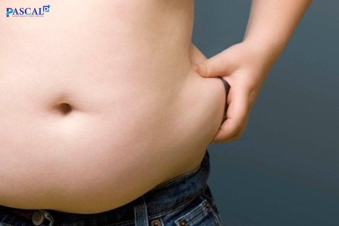 Mỡ bụng dưới là những chất béo tích tụ nhiều ở vùng bụng dưới rốn