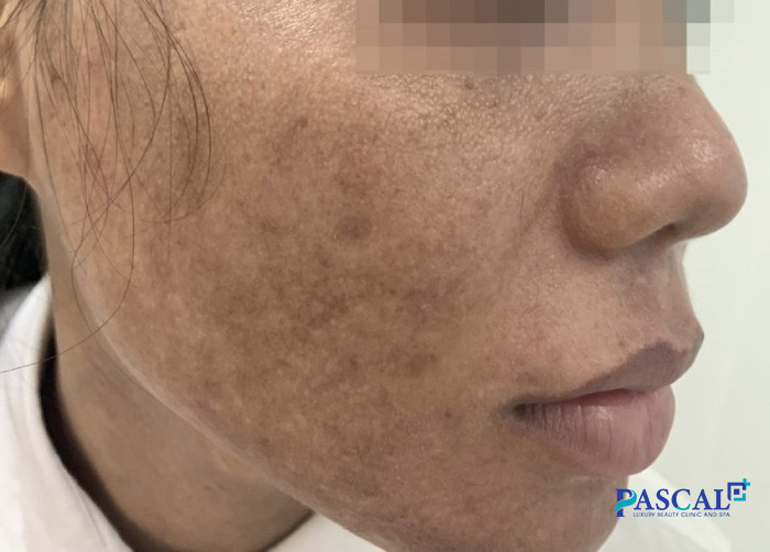 Trẻ hóa da bằng laser có thể gây ra tình trạng sẹo, mụn hay bỏng rát nếu thực hiện không đúng cách 