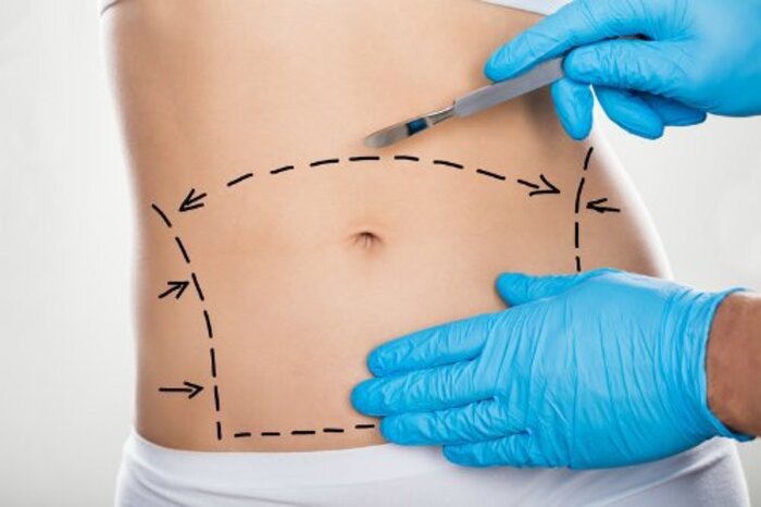 Cắt da bụng thừa là phương pháp loại bỏ da thừa, mỡ bụng bằng phẫu thuật, giúp thu nhỏ vòng bụng