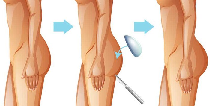 Nâng mông nội soi là phương pháp thẩm mỹ cải thiện mông bị lệch phổ biến 