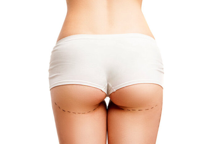 Nguyên nhân mông xệ là do di truyền, do thói quen sinh hoạt, mặc quần chật 