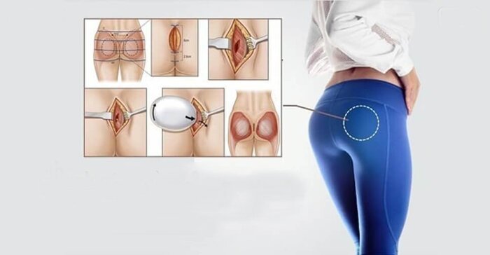 Nâng mông bằng túi độn là phương pháp cải thiện vòng 3 săn chắc có phẫu thuật, sử dụng túi độn nâng mông 