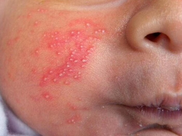 Bé 3 tuổi bị nổi mụn đầu trắng nguyên nhân do di truyền, môi trường bụi bẩn hay có thể do các bệnh lý về da 